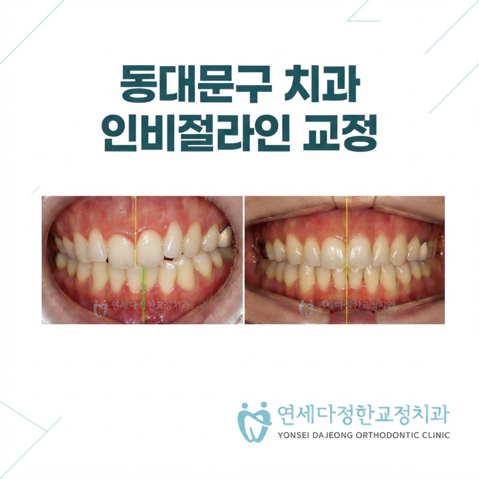 인비절라인 교정 비용