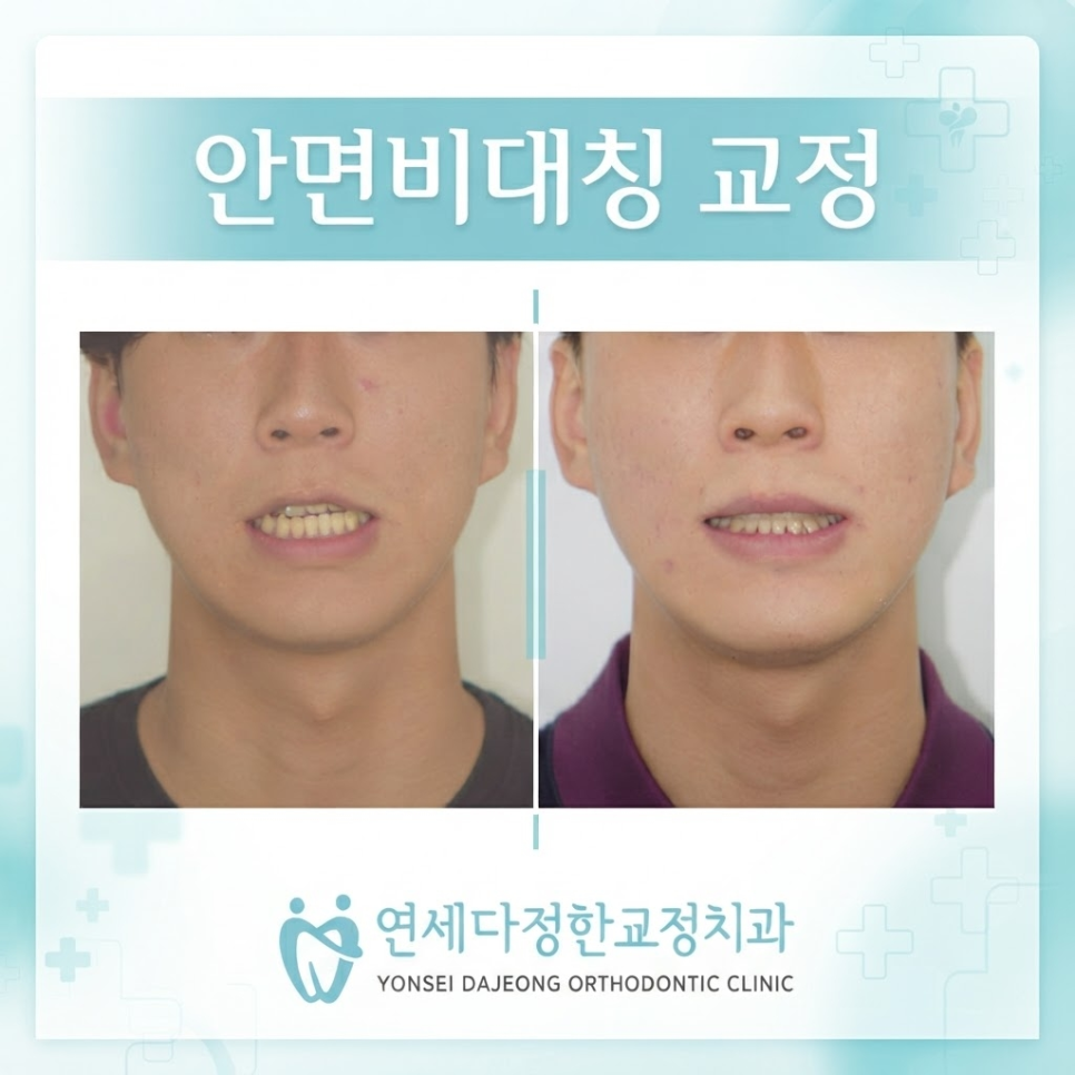안면비대칭 치아교정