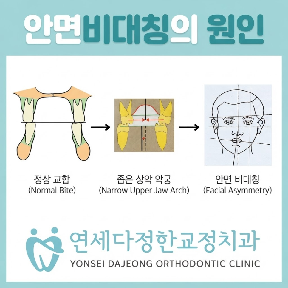안면비대칭 치아교정 관련 이미지 2
