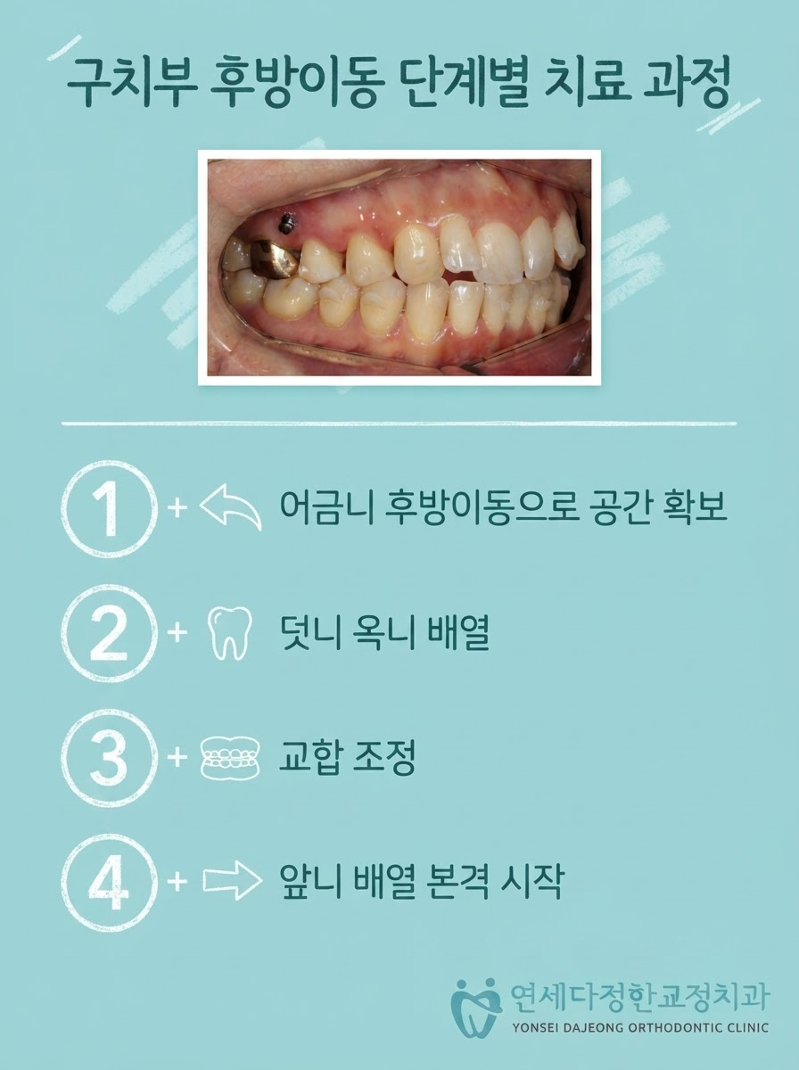인비절라인 교정 비용 관련 이미지 7