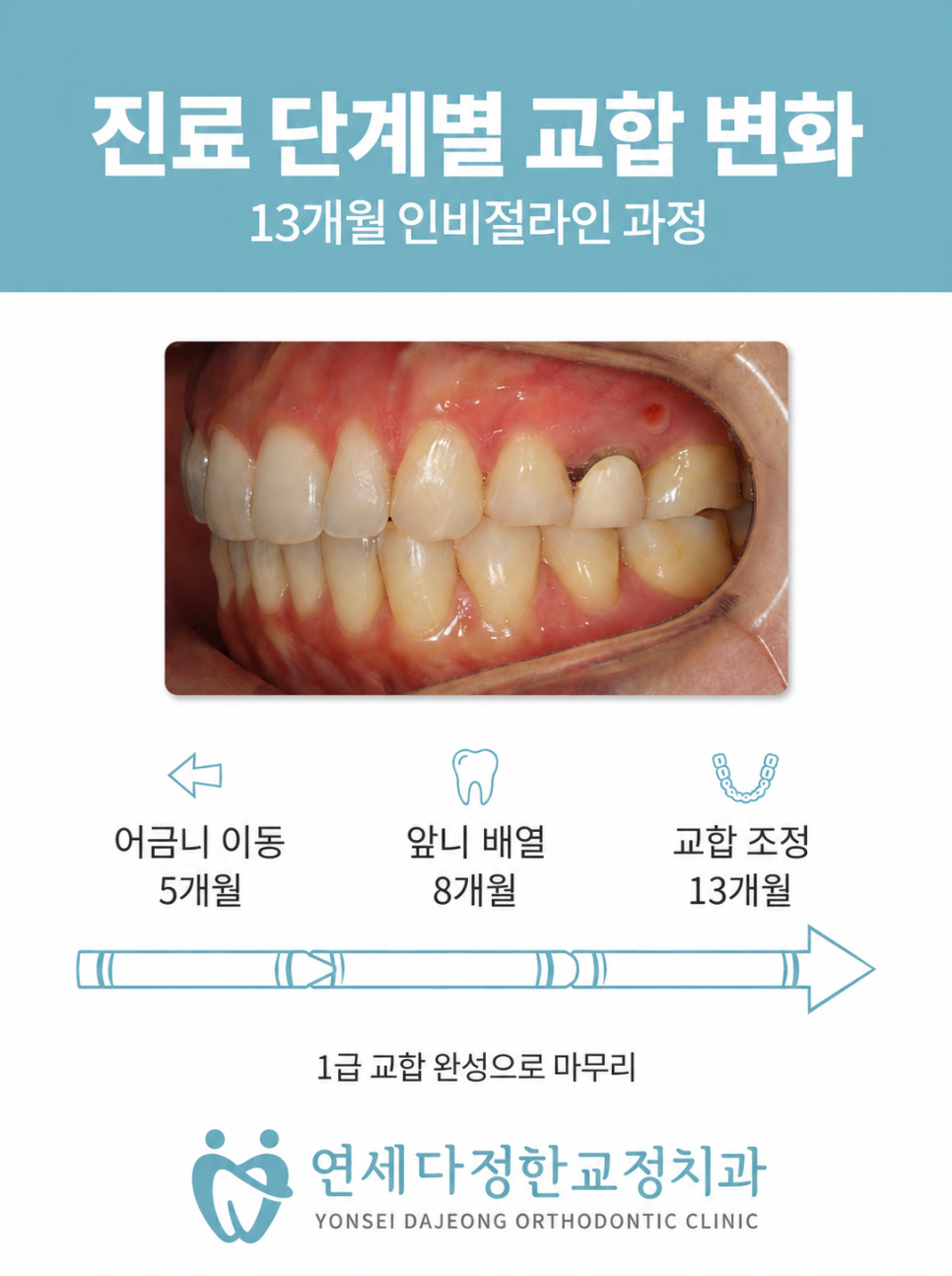 인비절라인 교정 비용 관련 이미지 9