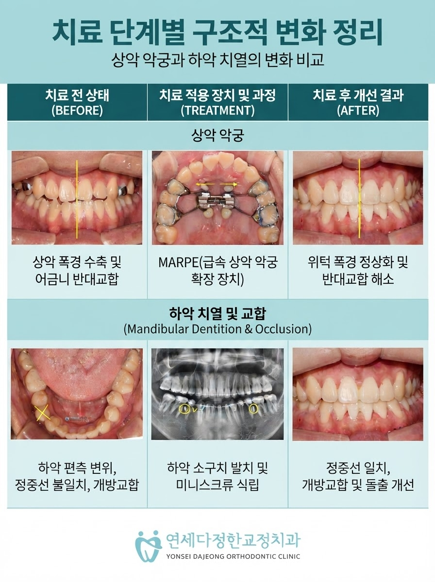 안면비대칭 치아교정 관련 이미지 10
