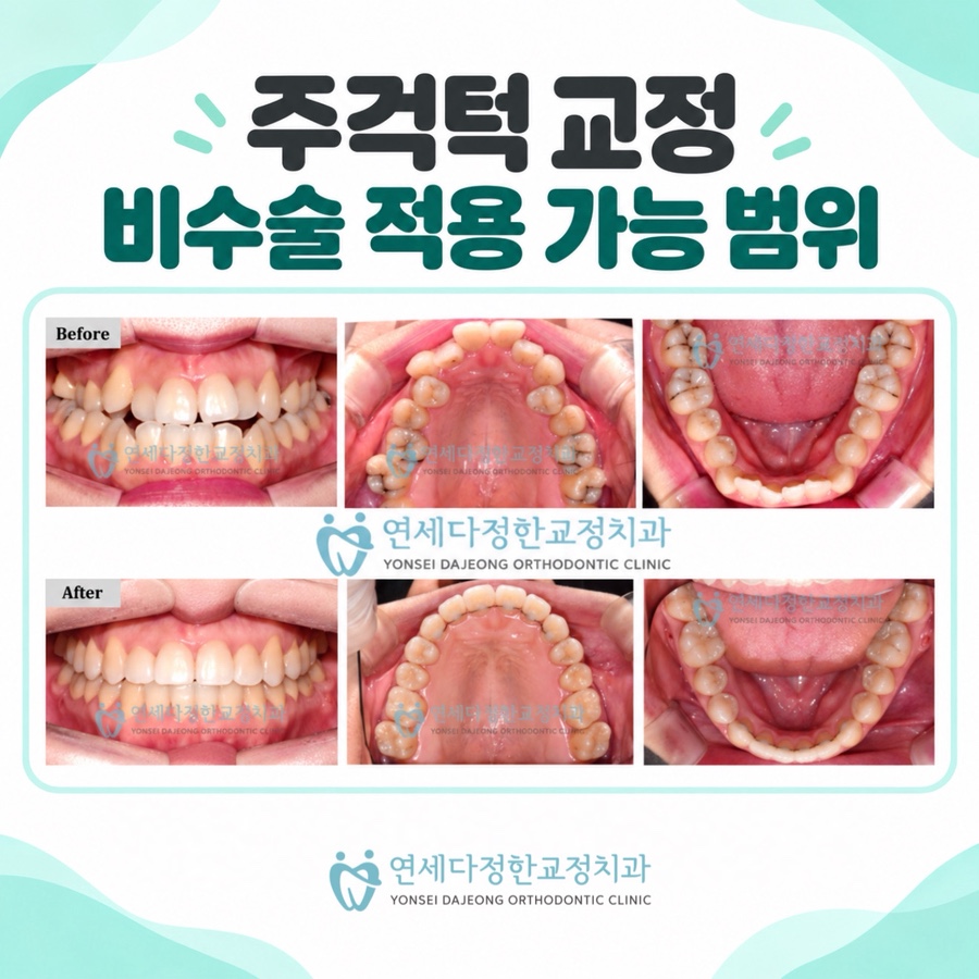 주걱턱 비수술교정 관련 이미지 8