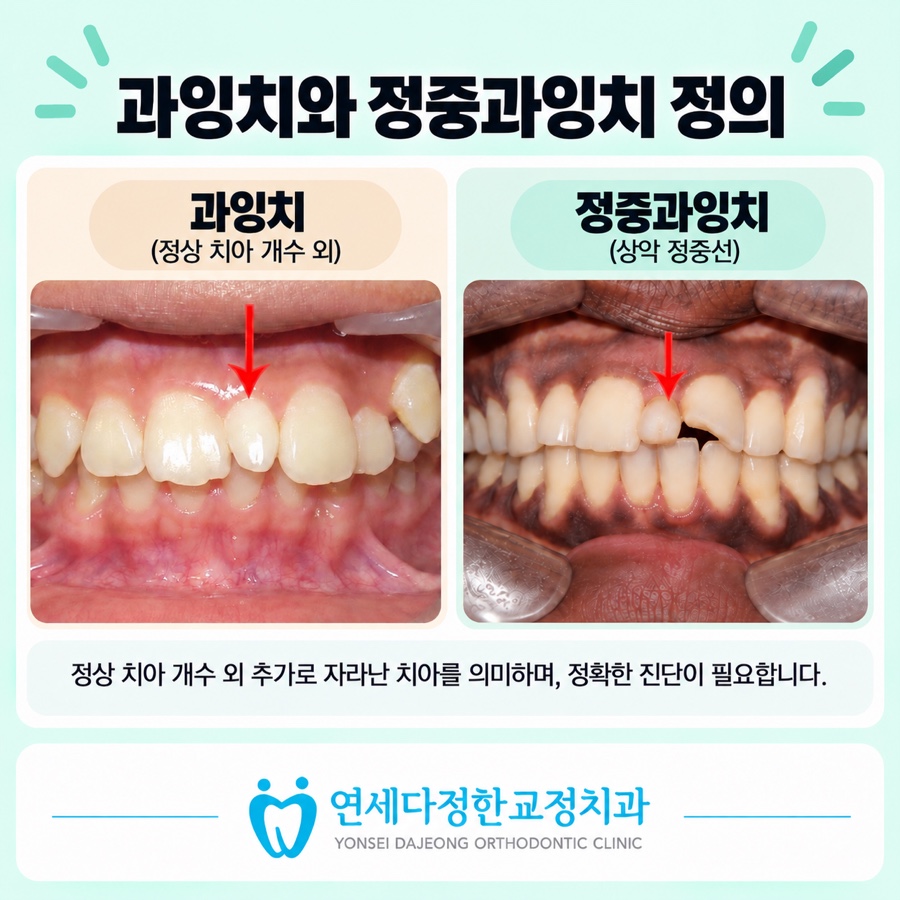 정중과잉치 관련 이미지 5