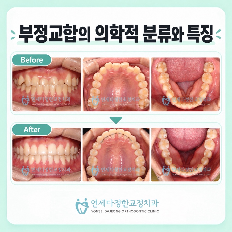 부정교합 치아교정 비용 관련 이미지 6