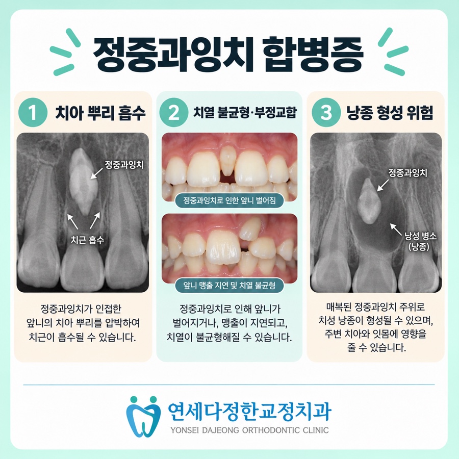 정중과잉치 관련 이미지 7