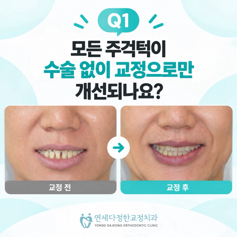 주걱턱 비수술교정 관련 이미지 14