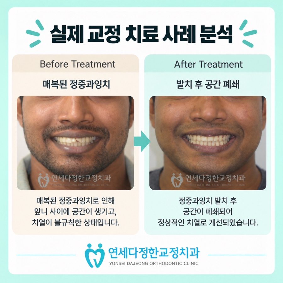 정중과잉치 관련 이미지 10