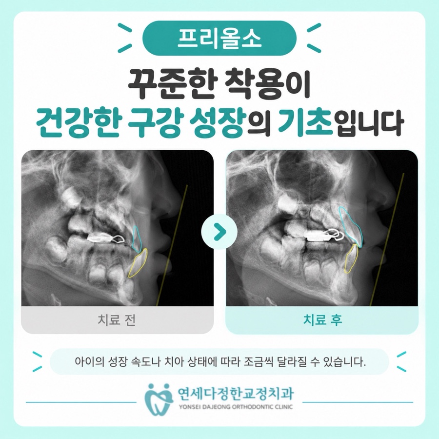 프리올소 효과 관련 이미지 11