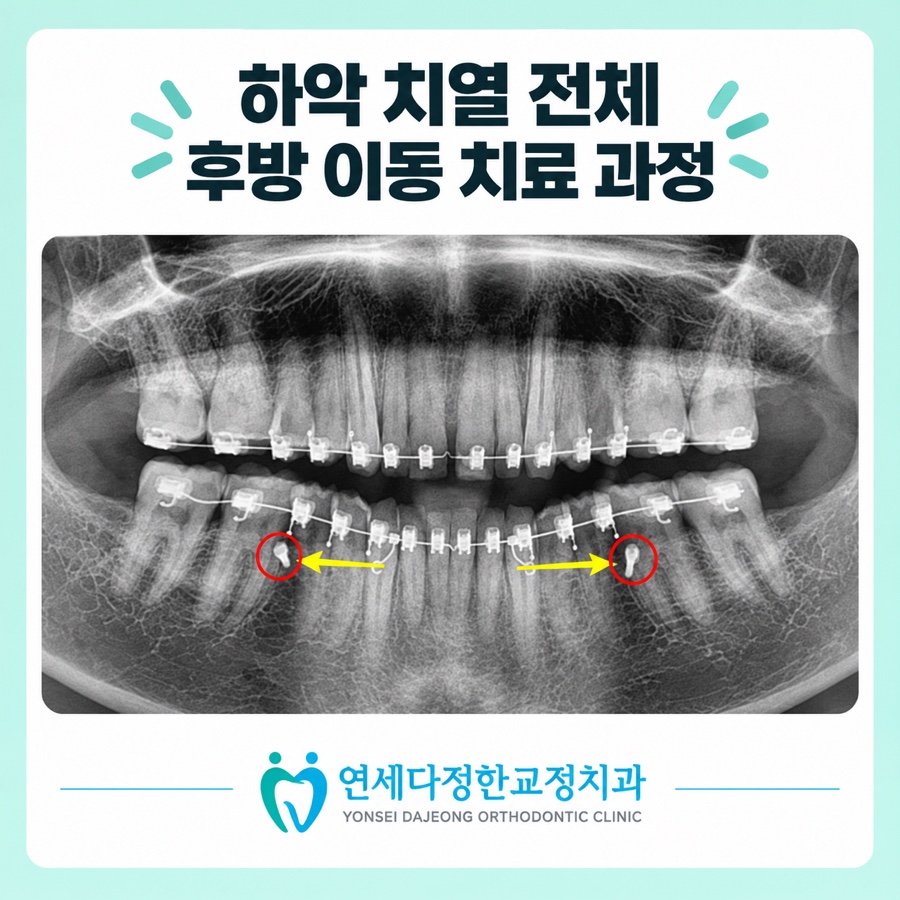 정중과잉치 관련 이미지 11