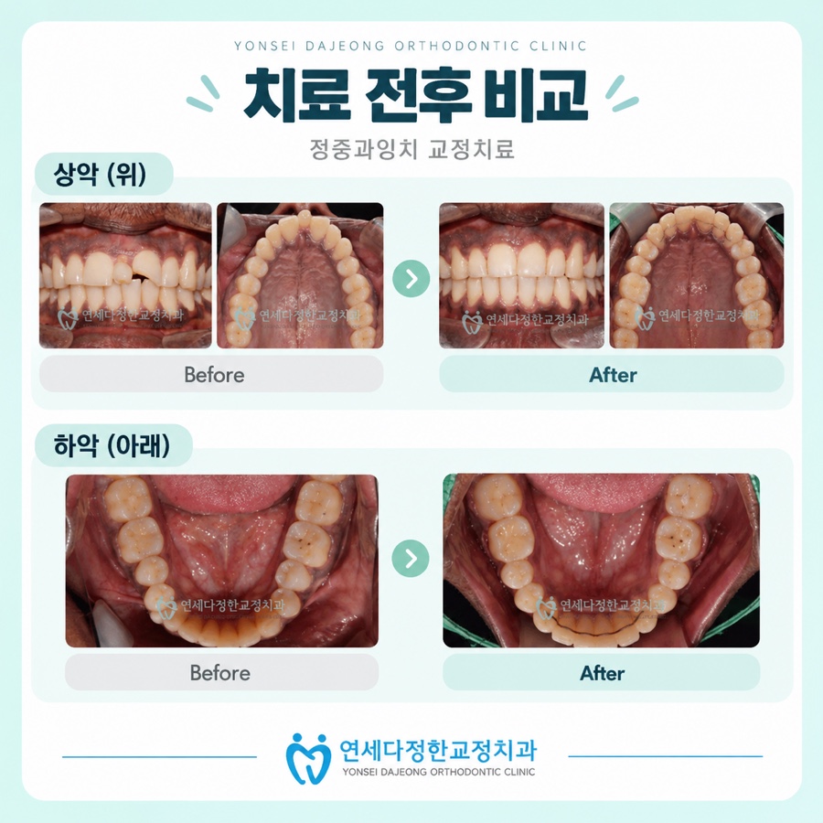 정중과잉치 관련 이미지 12