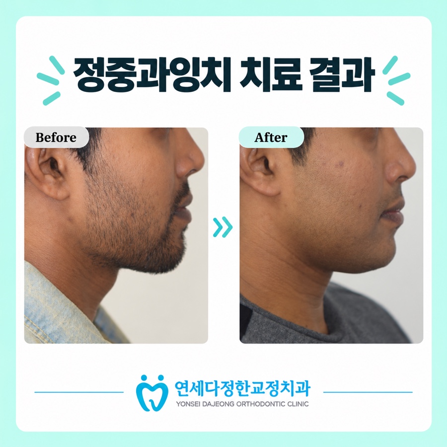 정중과잉치 관련 이미지 13