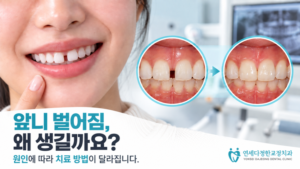앞니 벌어짐 교정