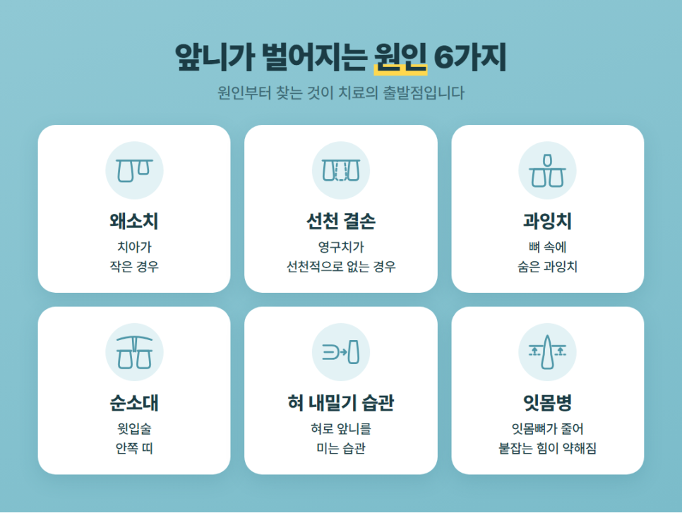 앞니 벌어짐 교정 관련 이미지 2