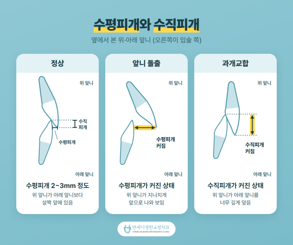 어린이 앞니 돌출 관련 이미지 2