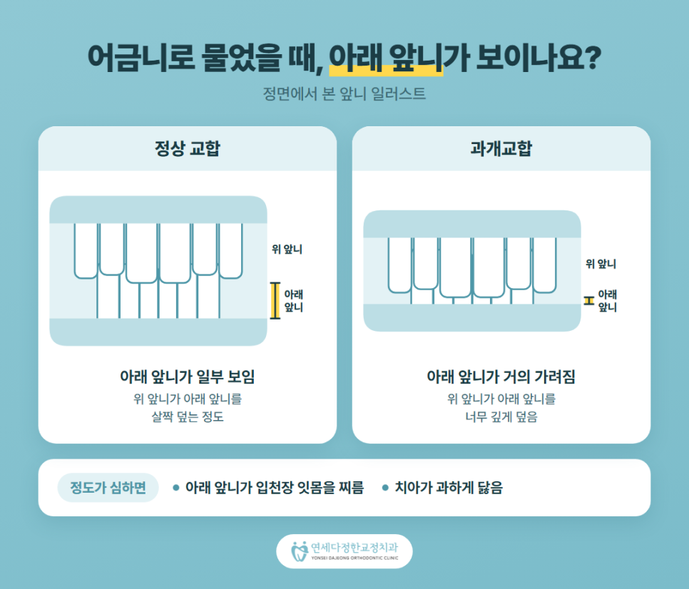 어린이 앞니 돌출 관련 이미지 3