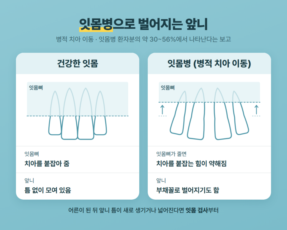 앞니 벌어짐 교정 관련 이미지 4