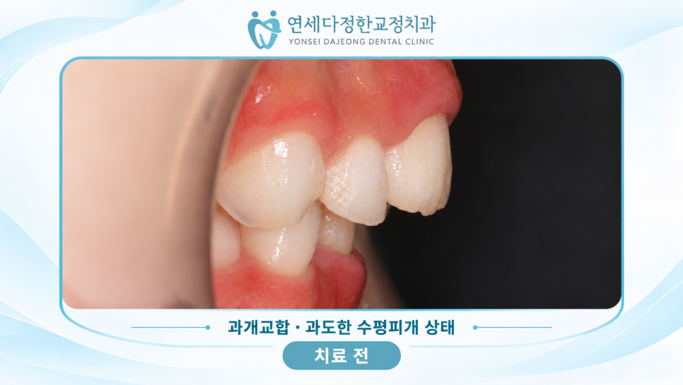 어린이 앞니 돌출 관련 이미지 4