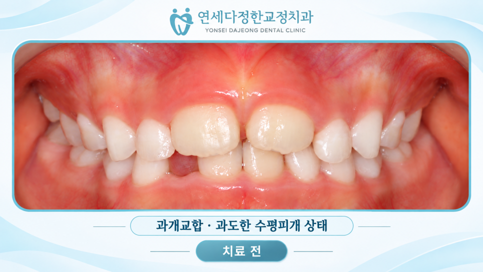 어린이 앞니 돌출 관련 이미지 5