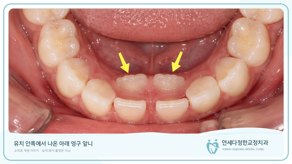 영구치 나오는 순서 관련 이미지 6