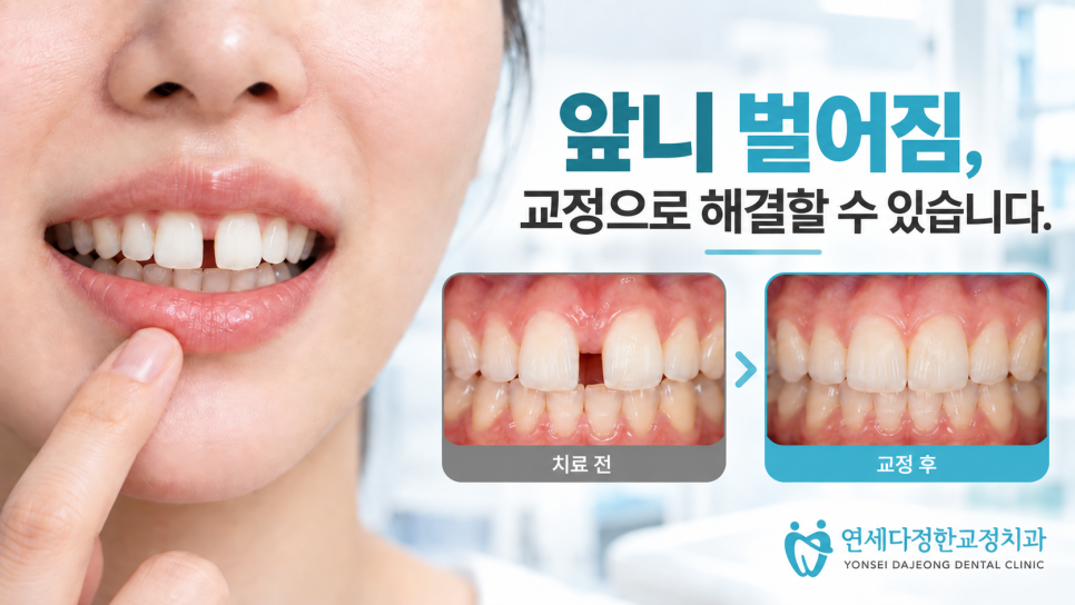 앞니 벌어짐 교정 관련 이미지 7