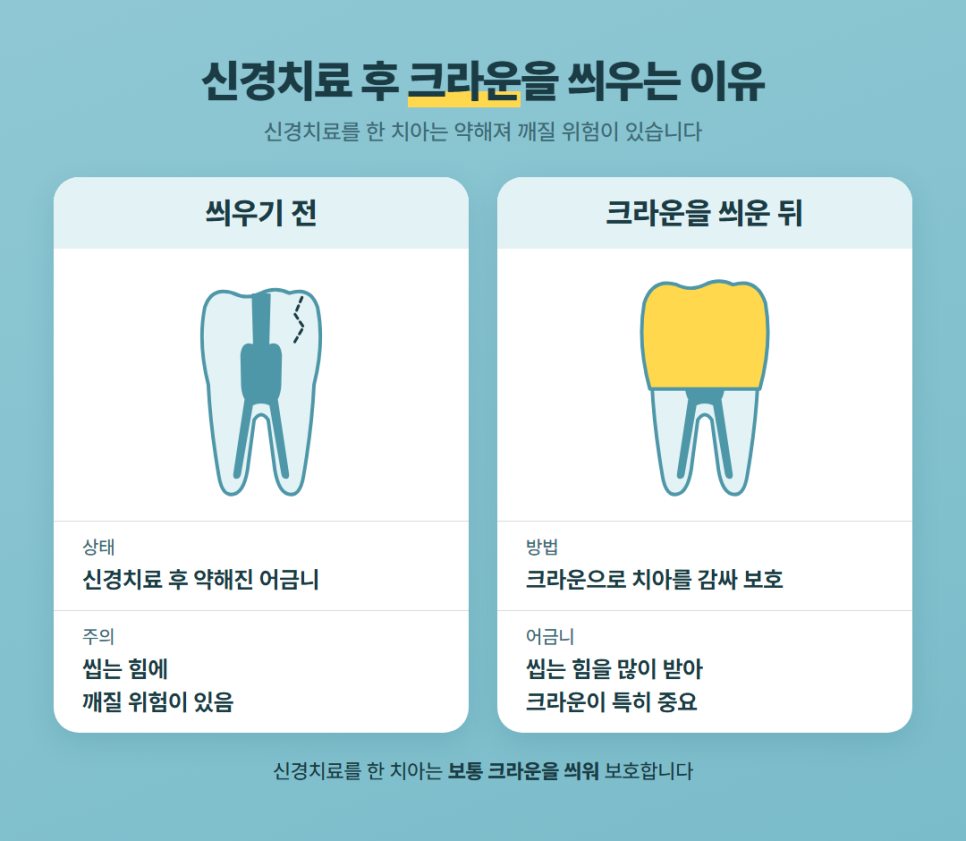 시린이 신경치료 관련 이미지 8