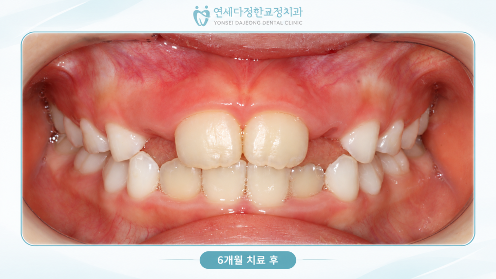 어린이 앞니 돌출 관련 이미지 9
