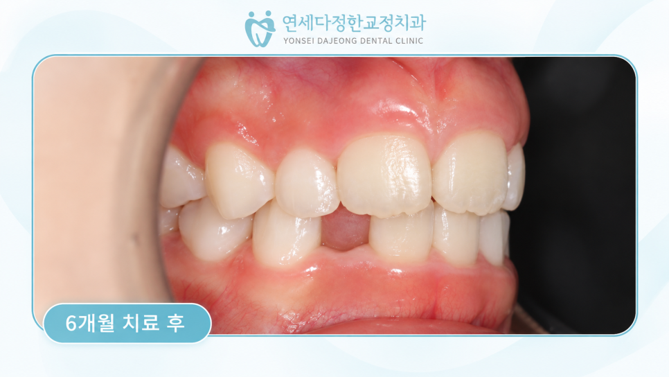 어린이 앞니 돌출 관련 이미지 10