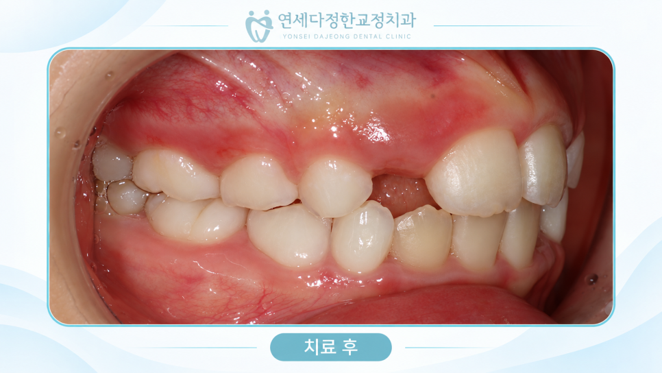 어린이 앞니 돌출 관련 이미지 12