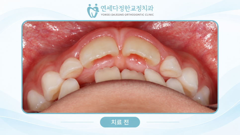 어린이 앞니 돌출 관련 이미지 13